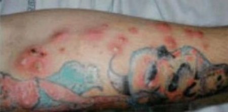 This Is What An Infected Tattoo Looks Like.